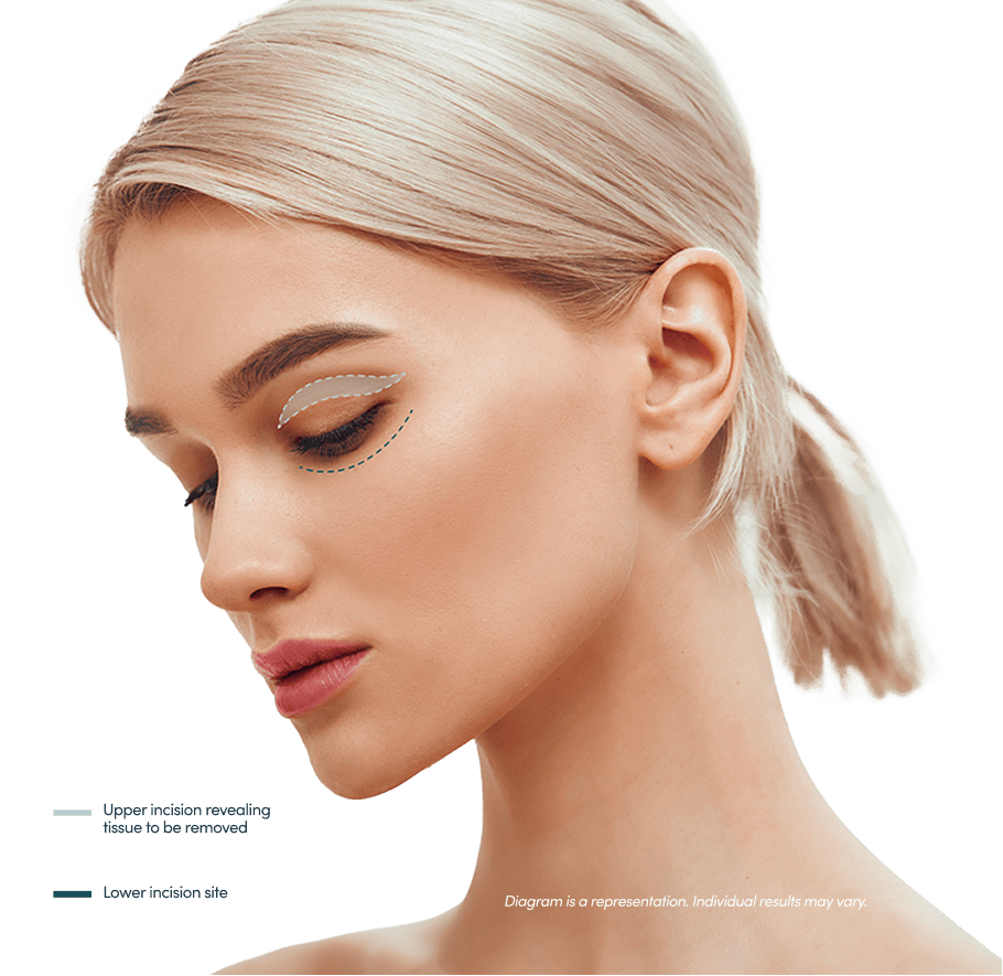 Diagram depicting blepharoplasty procedure. The area above a model's eyelid is indicated with a curved graphic shape, indicating the lines of the upper incision and the tissue to be reomved. A curved line under the eye indicates the lower incision site.